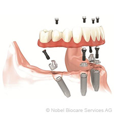 All-on-4: fogatlanság 4 implantátummal, csontpótlás nélkül all-on-4-fogatlansag-4-implantatummal-csontpotlas-nelkul-small