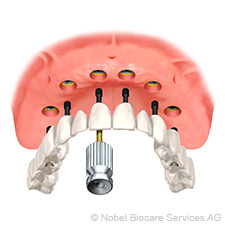 Csavarozott híd 6 implantátumon – az Ön biztonságáért csavarozott-hid-6-implantatumon-az-on-biztonsagaert-small