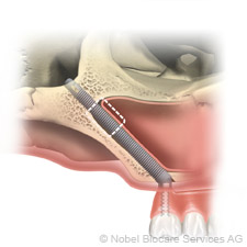 Hátsó Zygoma implantátum az arcüreg oldalán hatso-zygoma-implantatum-az-arcureg-oldalan-small
