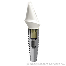 Implantátum cirkon felépítménnyel, még korona nélkül implantatum-cirkon-felepitmennyel-meg-korona-nelkul-small