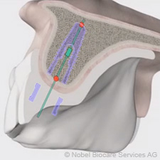 NobelGuide-implantáció műtét nélkül: így történik nobelguide-implantacio-mutet-nelkul-igy-tortenik