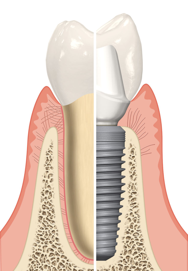 Immediate Implant Placement