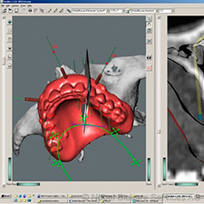 Implantation ohne chirurgischen Eingriff: NobelGuide implantation-ohne-chirurgischen-eingriff-nobelguide2-small