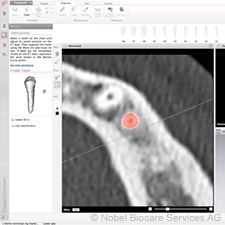NobelGuide CAD – izrada plana nobelguide-cad-making-a-plan