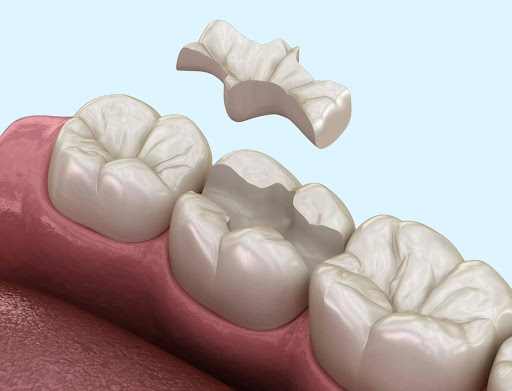 CEREC kerámia betét és Hagyományos betét