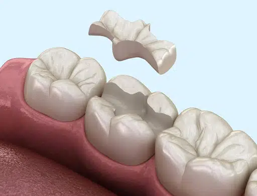 CEREC kerámia betét és Hagyományos betét
