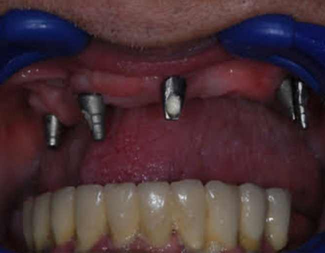 all-on-4-mutet-kep-1