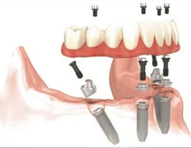 all-on-4-mutet-kep-2