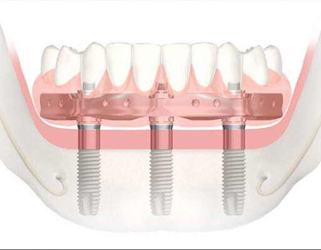 trefoil-implantácio-kep-1
